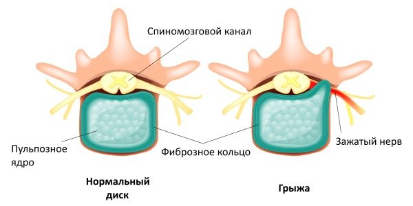 Пульпозное ядро выпадает наружу из-за дегенеративно-деструктивных изменений в межпозвонковом диске