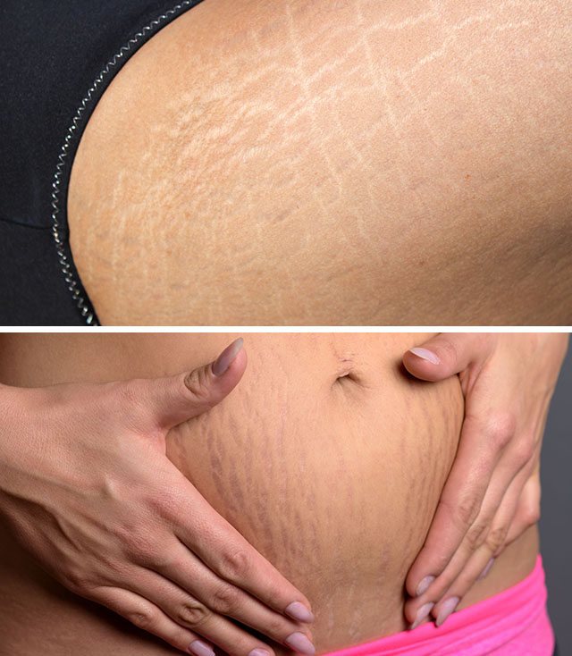 Растяжки на теле