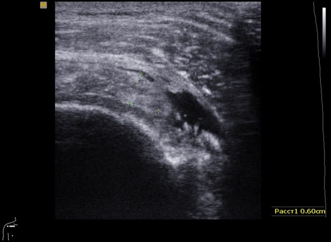 Разрыв связок плечевого сустава на снимке УЗИ