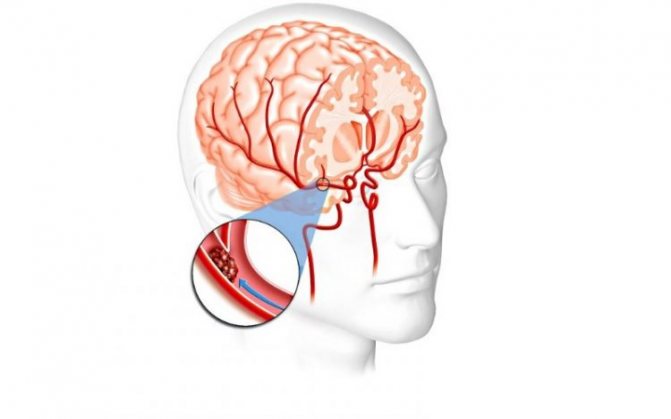 Развитие инсульта