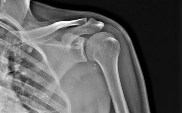 Результаты рентгена плечевого сустава