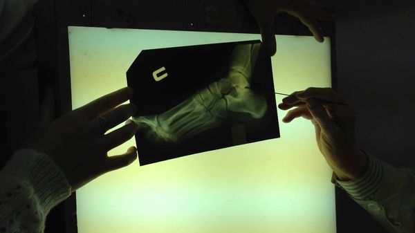 Результаты рентгена