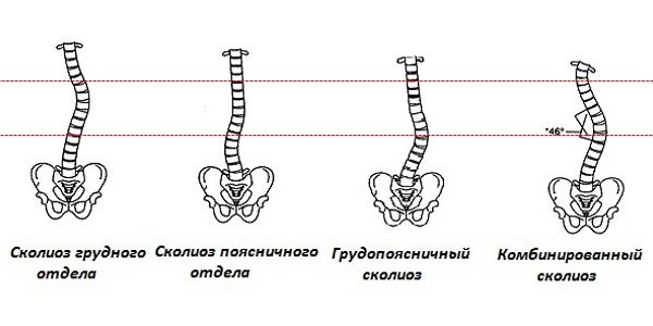 Самый сложный сколиоз - комбинированный