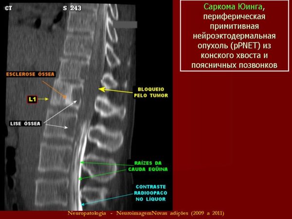 Саркома Юинга