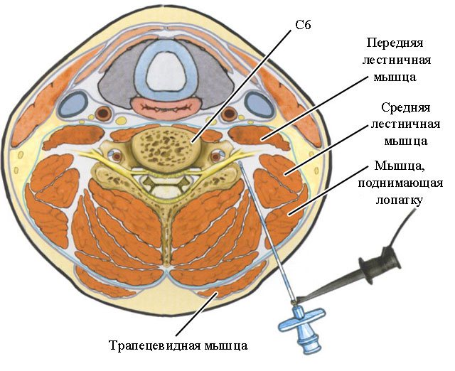 схема проведения паравертебральной блокады