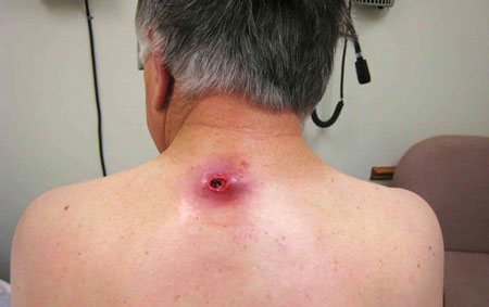 Шишка на позвоночнике в поясничном отделе