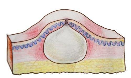 Шишка на позвоночнике в поясничном отделе