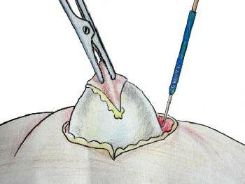 Шишка на позвоночнике в поясничном отделе