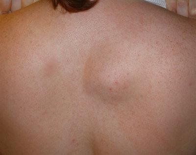 Шишка на позвоночнике в поясничном отделе