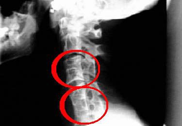 Шишка на позвоночнике в поясничном отделе