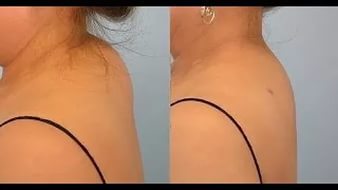 Шишка на позвоночнике в поясничном отделе