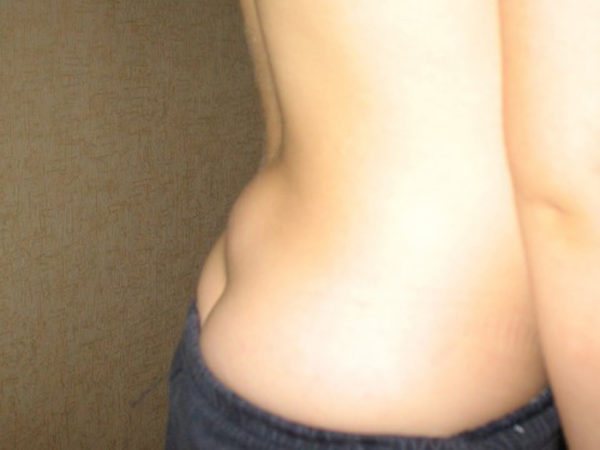 Шишка в районе поясницы