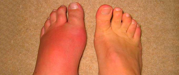 Сильное воспаление на ноге