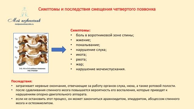 Симптомы смещения четвертого
