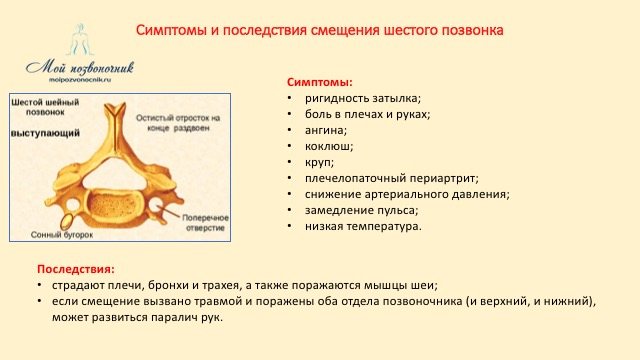 Симптомы смещения шестого