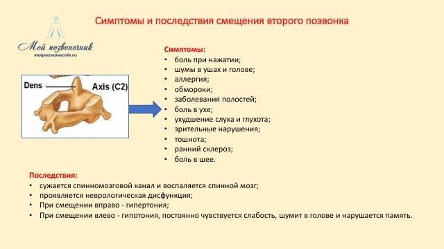 симптомы смещения второго
