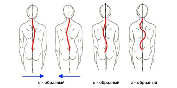 Сколиоз также бывает право- и левостороним