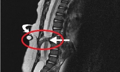 Спина Бифида диагностика