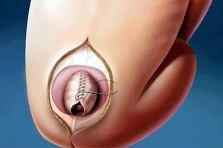 Спина бифида хирургическая операция