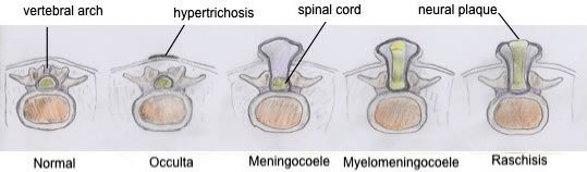 Спина Бифида - классификация