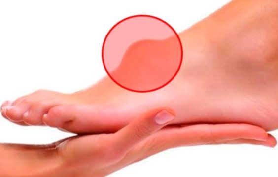 Так выглядет гигрома на ноге