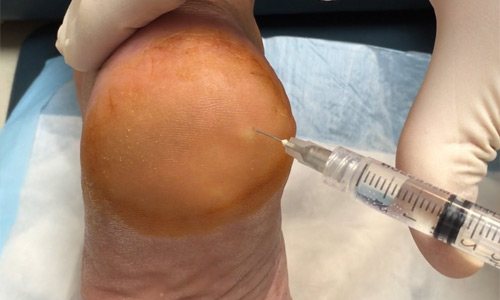 Техника инъекции Дипроспана