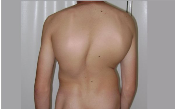 Третья степень сколиоза характеризуется выраженной деформацией туловища