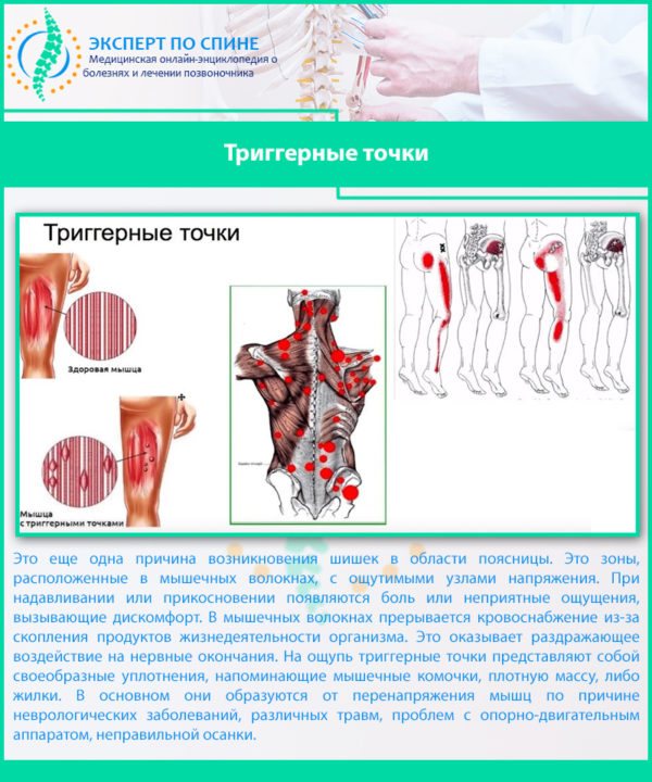 Триггерные точки
