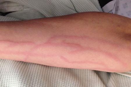 Тромбофлебит