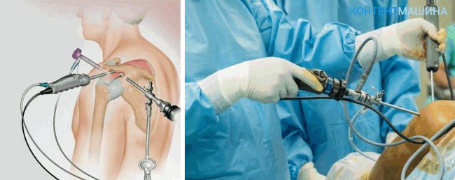 unnamed file 30 - Артроскопия плечевого сустава: как проходит операция и какие у нее последствия?