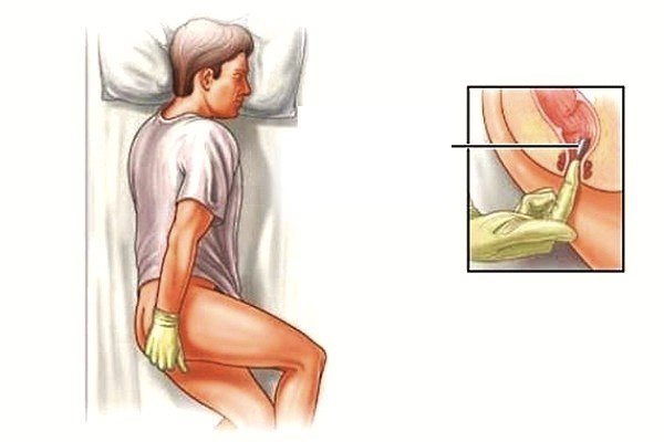 Вольтарен свечи при простатите