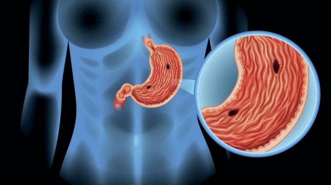 Язва желудка