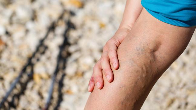 тренировки при варикозе