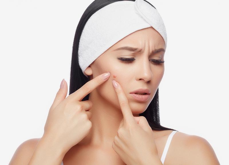 у девушки прыщ на лице