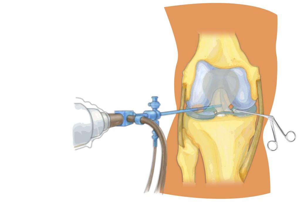 Операция на колене