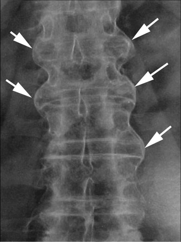 Протрузии позвоночника
