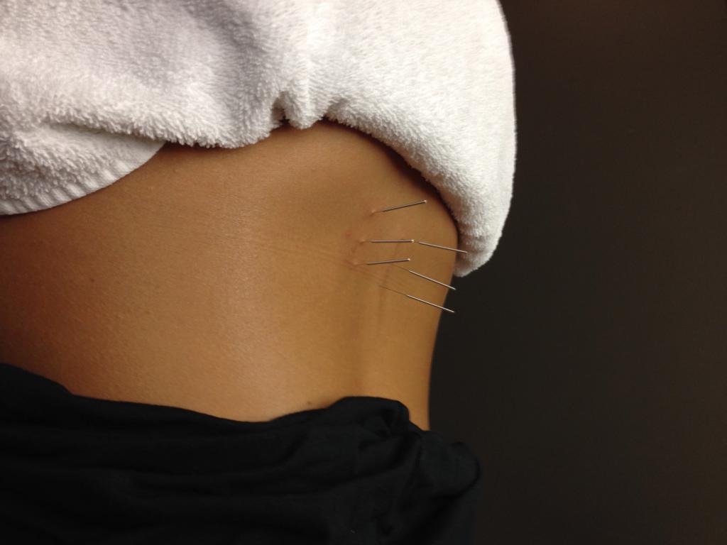 Практика иглотерапии