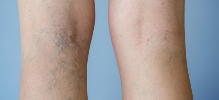 вены при варикозе