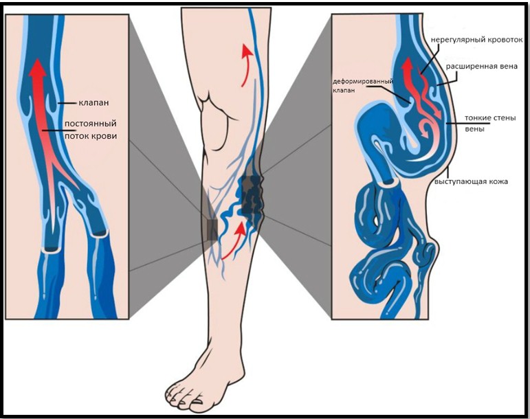 патология вены