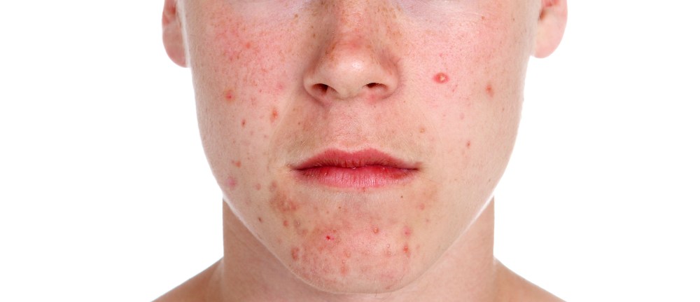 побочное действие в виде прыщей