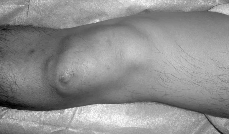 колено прыгуна бандаж