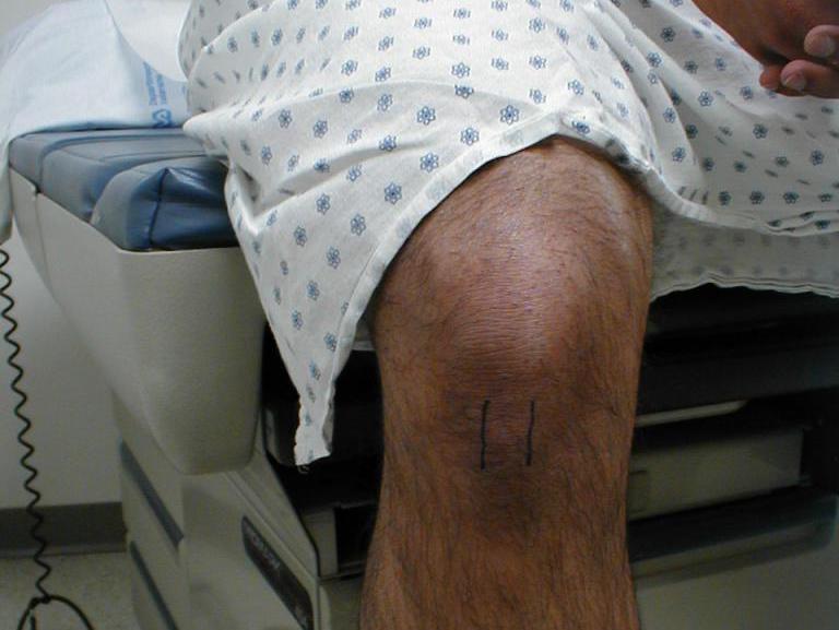 колено прыгуна