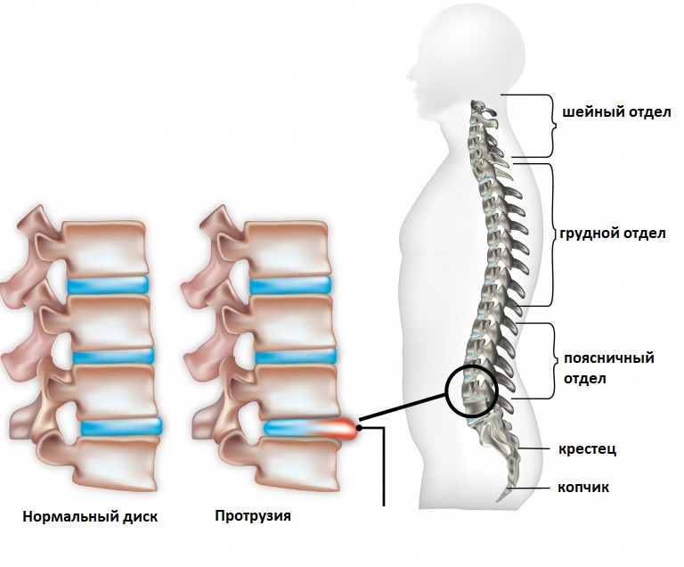 Протрузия диска