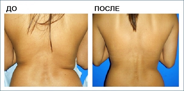До и после мезотерапии