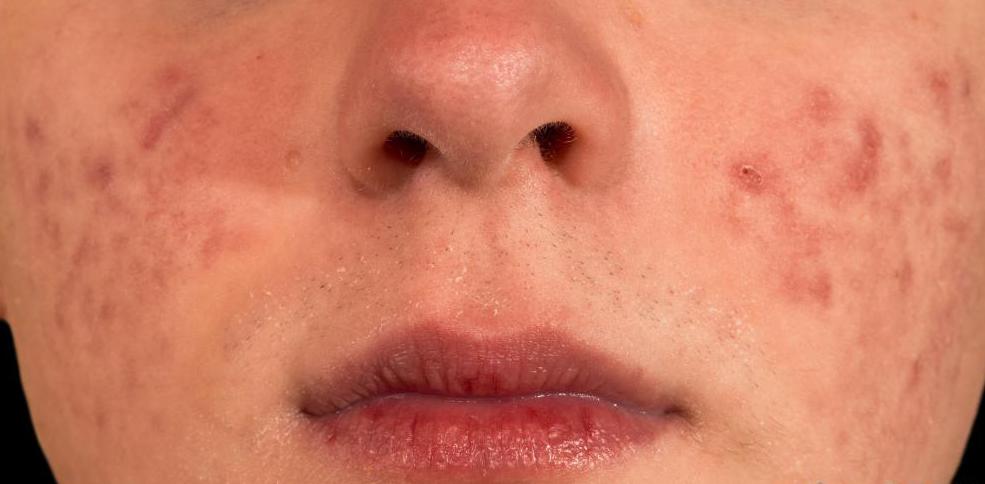 угревая сыпь от станозолола