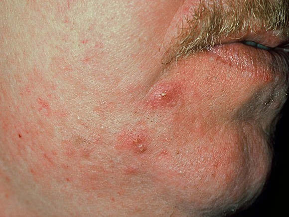 Акне от стероидов