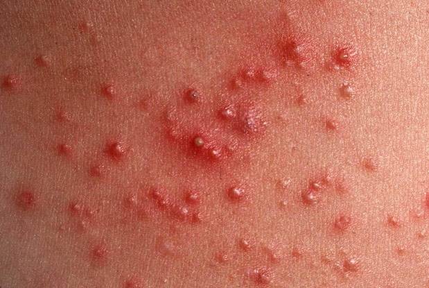 Акне после курса стероидов