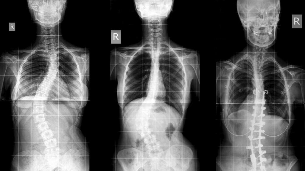 Сколиоз: один из видов деформации тела