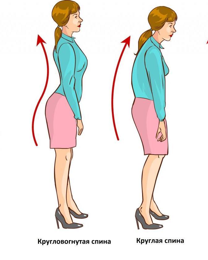 Нарушения осанки