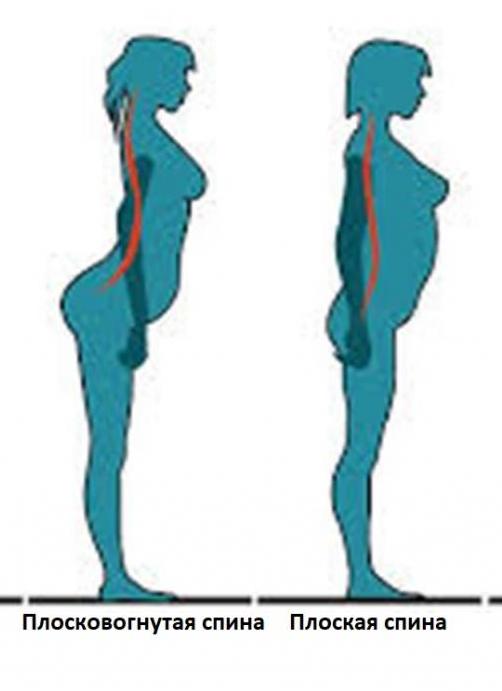 Нарушения осанки